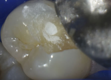 箕面市の寺嶋歯科医院の歯の神経の保存治療